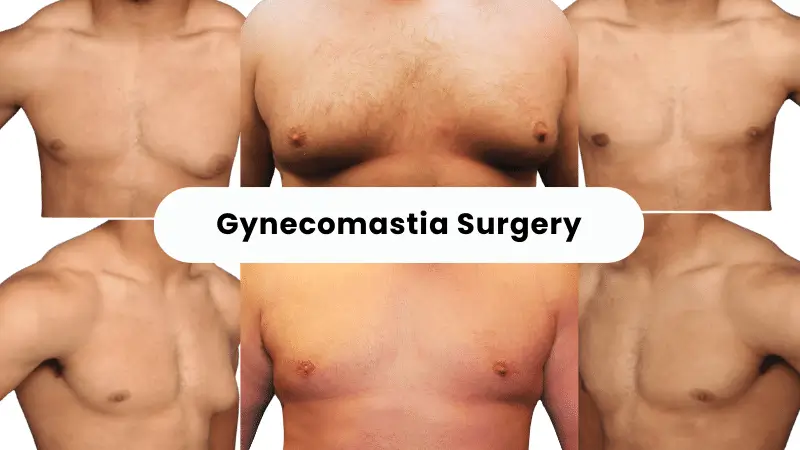 Cheap Gynecomastia Surgery Abroad